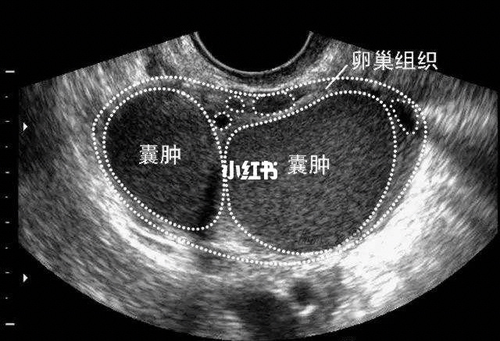卵巢囊肿囊壁厚是什么意思