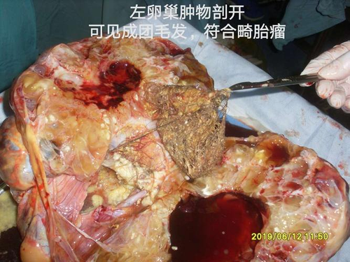 卵巢囊肿会导致肚子变大吗 卵巢囊肿会导致肚子变大吗