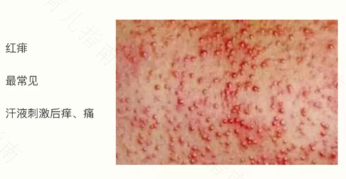 大人冬天会长痱子吗