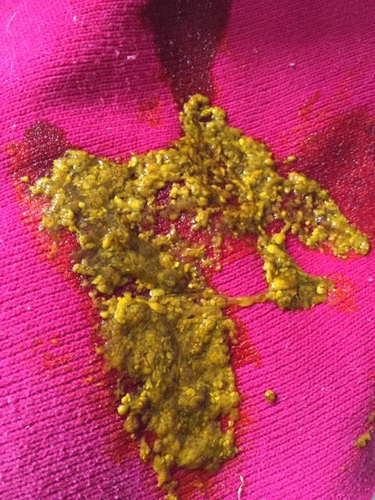 大便严重拉不出来怎么办 大便严重拉不出来怎么办