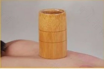 减肥拔火罐拔哪个部位 减肥拔火罐拔哪个部位