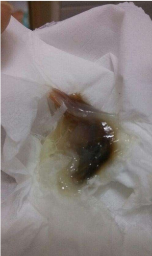 细菌性阴炎会出血吗 细菌性阴炎会出血吗