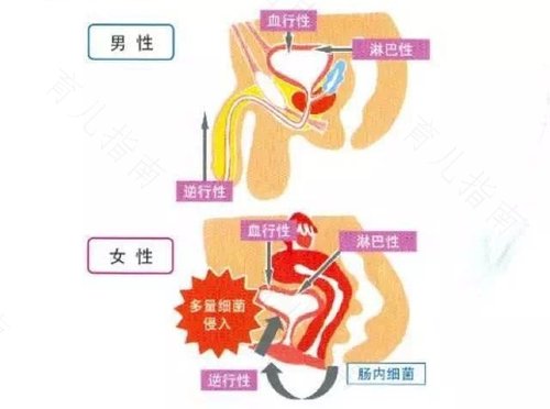 女性为什么会反复尿路感染 女性为什么会反复尿路感染