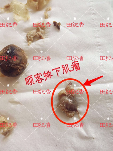 子宫大出血有什么症状 子宫大出血有什么症状