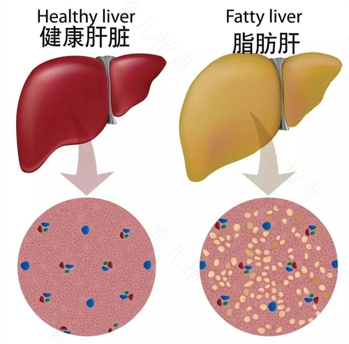 脂肪肝严重吗?会不会传染 脂肪肝严重吗?会不会传染