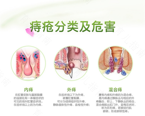 痔疮很痒怎么治疗 痔疮很痒怎么治疗