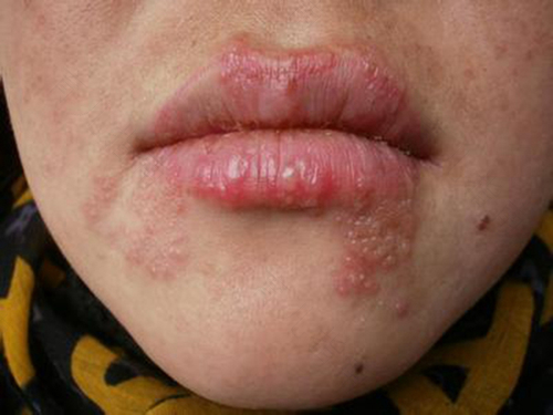 小孩嘴巴长疱疹怎么办 小孩嘴巴长疱疹怎么办