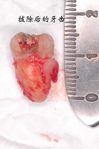 阻生智齿不疼一定要拔吗