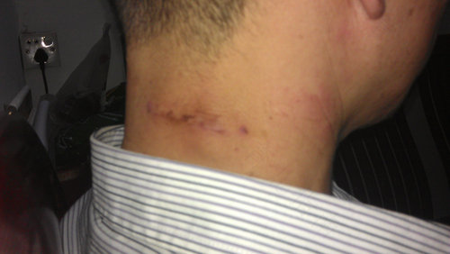 脂肪瘤对人体的危害有多大 脂肪瘤对人体的危害有多大