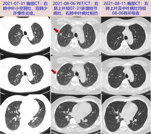 肺结核胸痛是哪里痛 肺结核胸痛是哪里痛