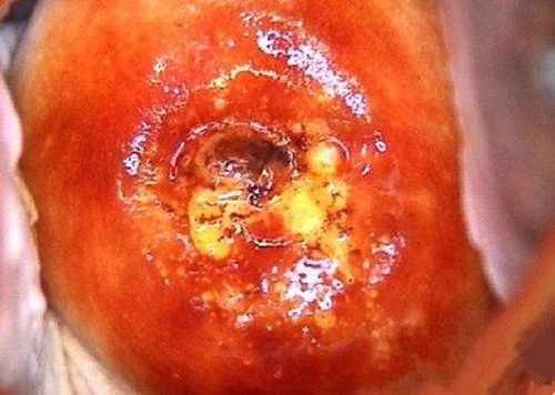 宫颈发炎是什么引起的? 宫颈发炎是什么引起的?