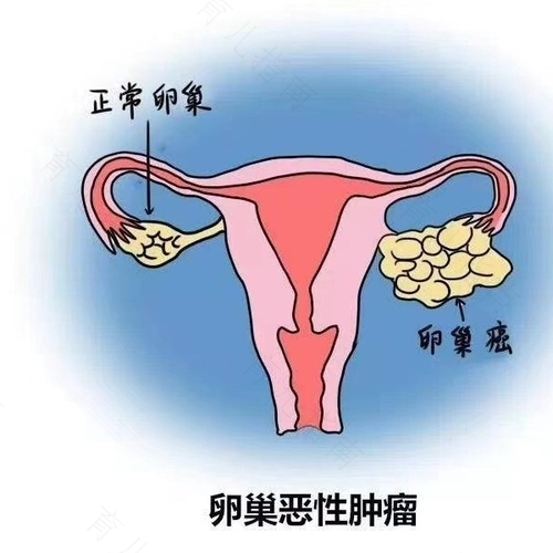 宫颈囊肿会导致不孕吗 宫颈囊肿会导致不孕吗