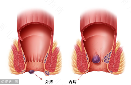 得了痔疮有什么症状? 得了痔疮有什么症状?
