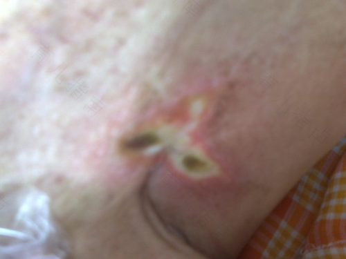 乳腺癌腋窝会疼吗 乳腺癌腋窝会疼吗