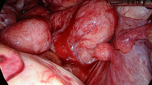 子宫肌瘤手术风险大吗? 子宫肌瘤手术风险大吗?