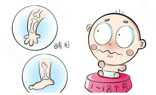 缺钙会患佝偻病吗 缺钙会患佝偻病吗