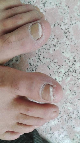 脚指甲变厚怎么治愈 脚指甲变厚怎么治愈