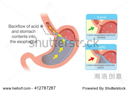 胃烧心怎么治疗胃烧心怎么治疗