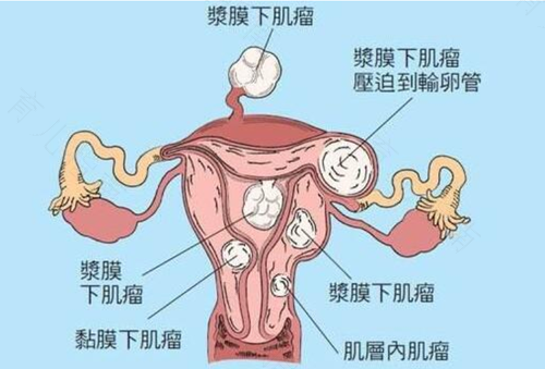 子宫肌瘤会出血多吗 子宫肌瘤会出血多吗