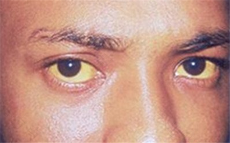 眼球发黄是怎么回事有血丝 眼球发黄是怎么回事有血丝