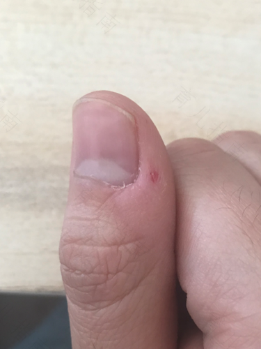 小孩手上有倒刺怎么办 小孩手上有倒刺怎么办