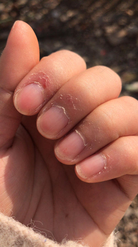 手上起刺是怎么回事儿 手上起刺是怎么回事儿