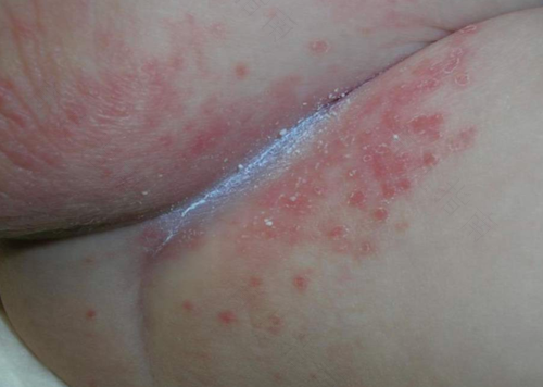 皮肤出湿疹是什么原因造成的 皮肤出湿疹是什么原因造成的