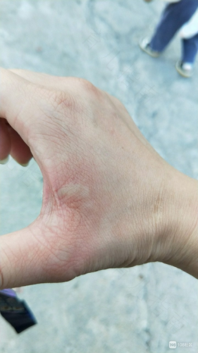 过敏性荨麻疹怎么除根 过敏性荨麻疹怎么除根