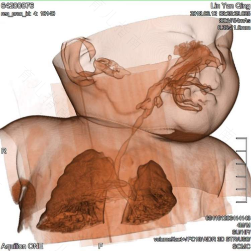 喉咙软骨发育不全怎么办 喉咙软骨发育不全怎么办