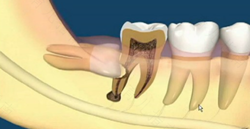 拔完智齿要打针消炎吗 拔完智齿要打针消炎吗