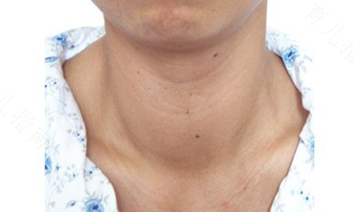 甲状腺炎有什么危害吗 甲状腺炎有什么危害吗