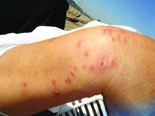 败血症的症状有哪些 败血症的症状有哪些