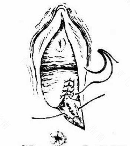 外阴痛疼痛是什么病因