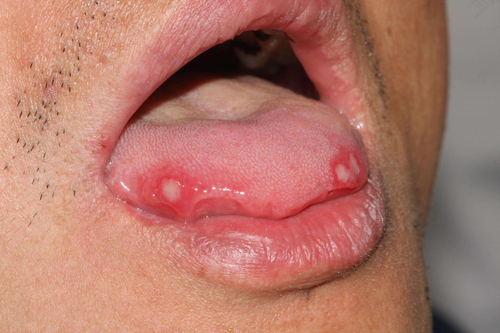 舌头白色念珠菌症状 舌头白色念珠菌症状