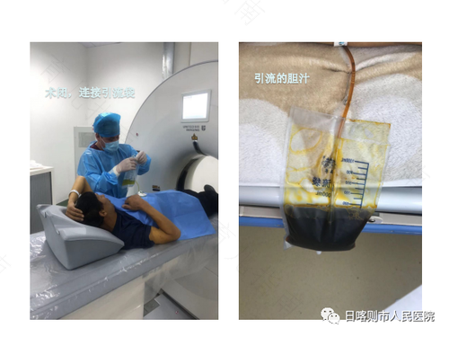 肝穿刺后几天可以洗澡 肝穿刺后几天可以洗澡