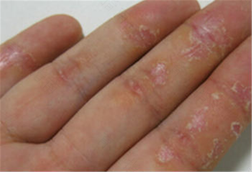 湿疹有遗传性吗 湿疹有遗传性吗