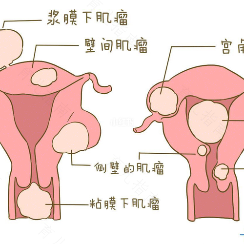 为什么容易长子宫肌瘤