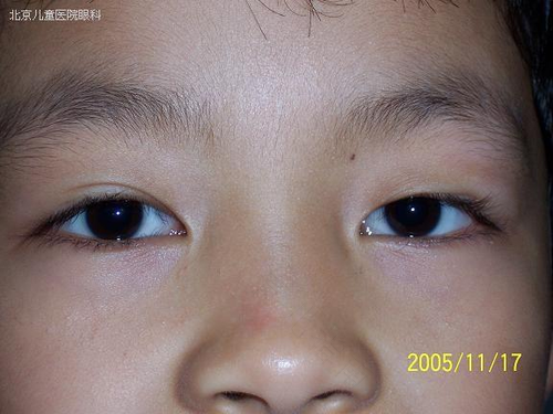 七个问答,搞清孩子针眼问题 七个问答,搞清孩子针眼问题