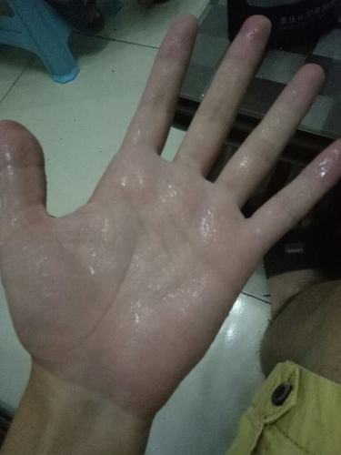 冬天手脚一直出汗怎么回事 冬天手脚一直出汗怎么回事