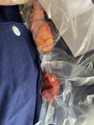 副乳切除手术会有疤痕吗 副乳切除手术会有疤痕吗