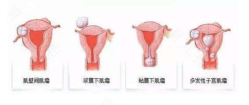 宫颈口肥大怎么治疗,能痊愈吗? 宫颈口肥大怎么治疗,能痊愈吗?