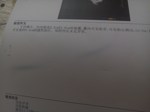 宫腔积液是先兆流产的迹象吗 宫腔积液是先兆流产的迹象吗