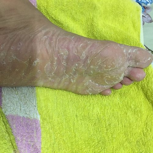 脚脱皮怎么办? 脚脱皮怎么办?