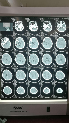 颅内感染的症状 颅内感染的症状