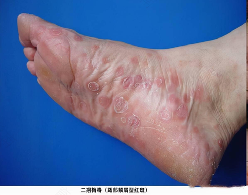 梅毒1期有什么症状 梅毒1期有什么症状