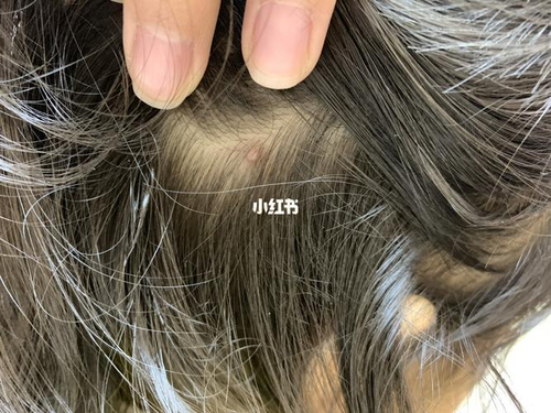 头顶头皮疼是怎么回事一按就会疼 头顶头皮疼是怎么回事一按就会疼