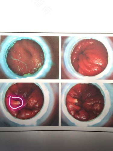 乳腺息肉怎么治疗 乳腺息肉怎么治疗