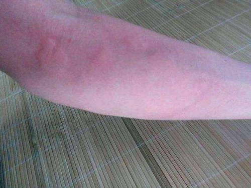突发过敏性荨麻疹怎么办 突发过敏性荨麻疹怎么办