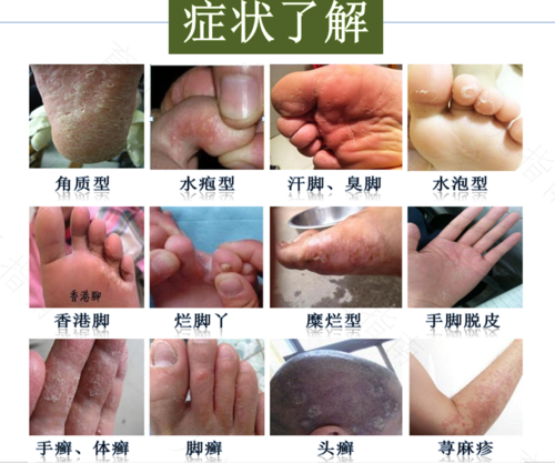 脚气蜕皮痒怎么办 脚气蜕皮痒怎么办