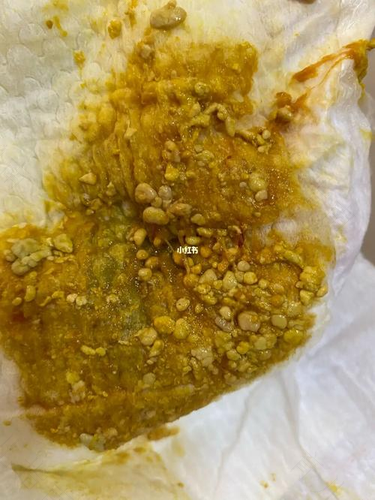 拉肚子便血怎么回事 拉肚子便血怎么回事